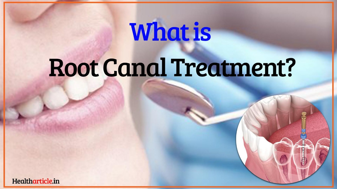 How to do Root Canal Step by Step and its Benefits